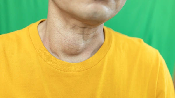 goiter