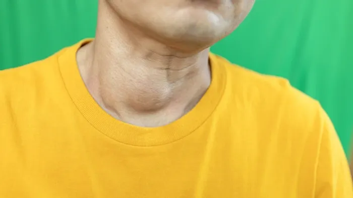 goiter