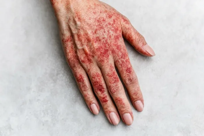 Petechiae