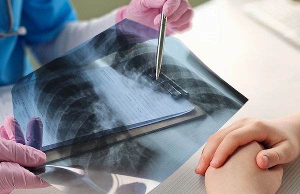Bone Cancer Overview: Symptoms, Causes, and Treatment
