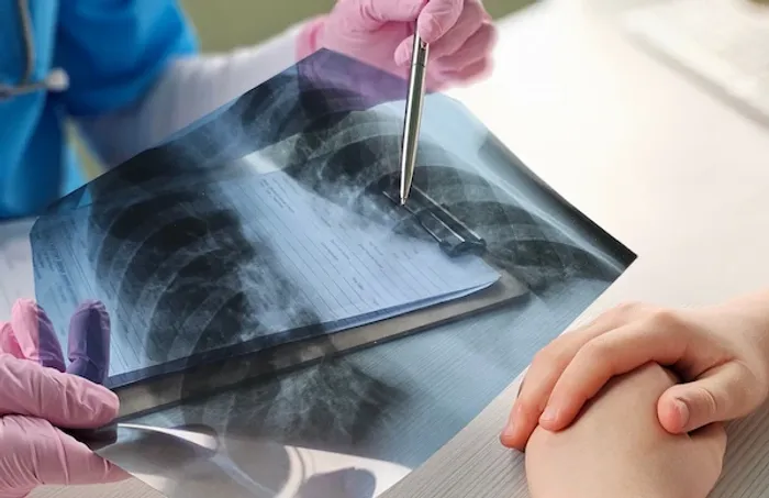 Bone Cancer Overview: Symptoms, Causes, and Treatment