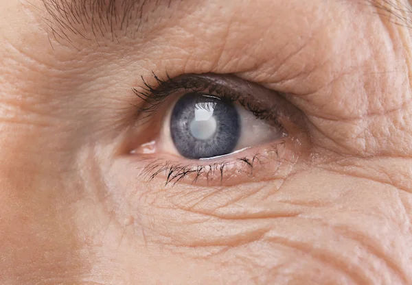 Understanding Glaucoma: Symptoms, Causes, and Treatment