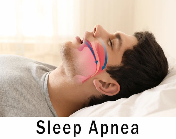 Sleep Apnea's