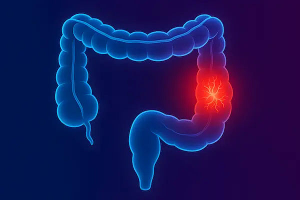Diverticulosis