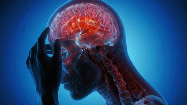 Blood Clot in Brain