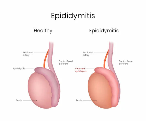 Varicocele Symptoms, Causes, and Treatment Options