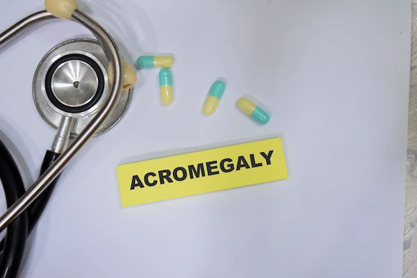 acromegaly