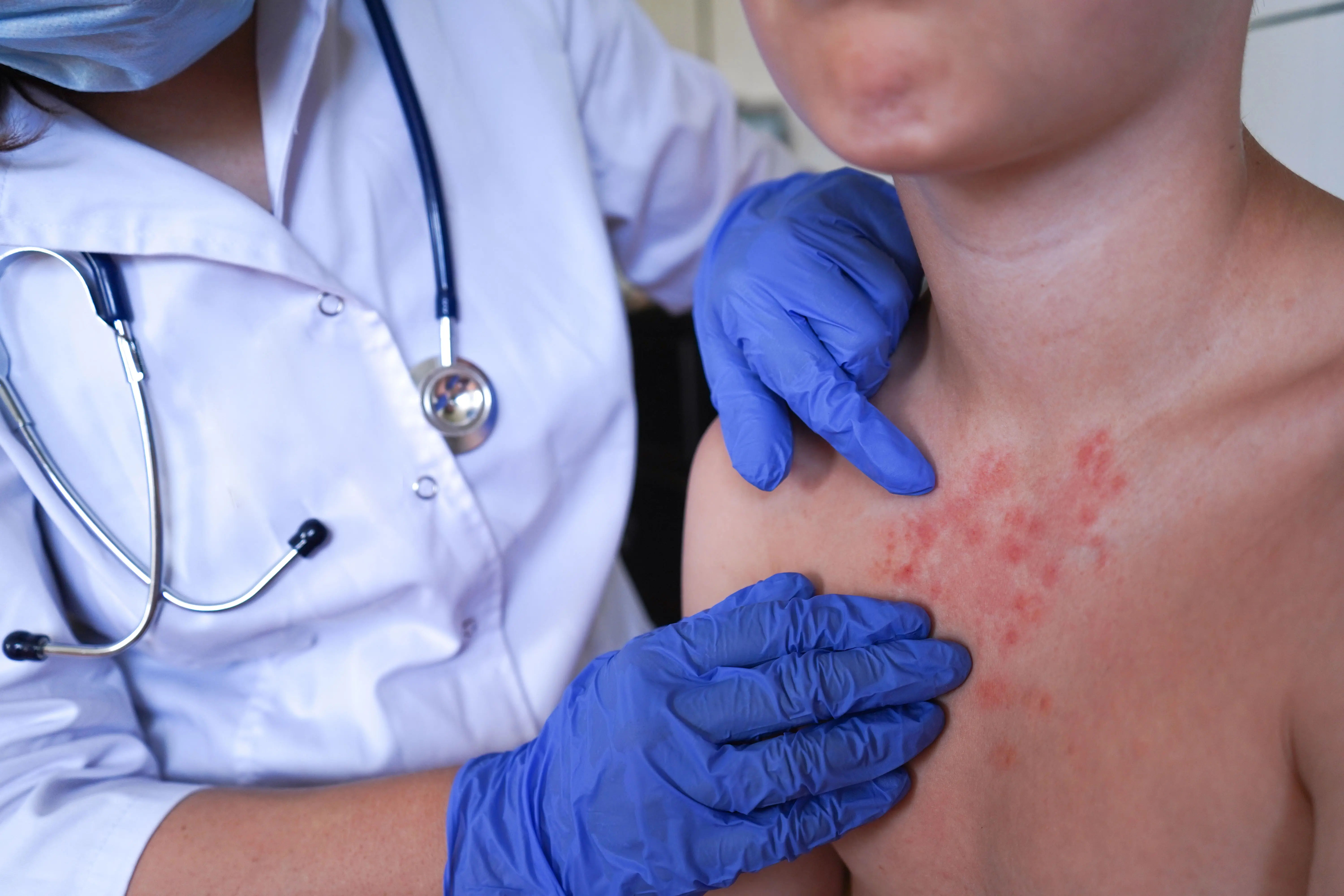 Lichen Planus