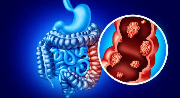 Malignant and Benign Tumours