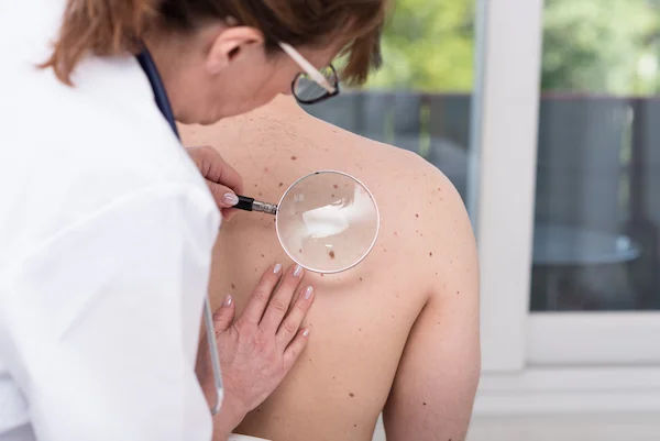 Skin Cancer in People of Colour Worldwide