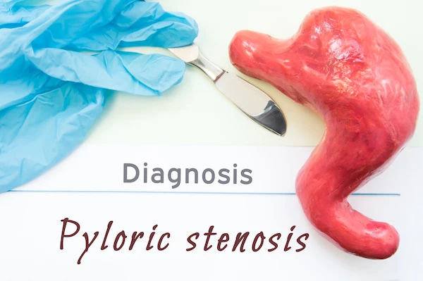 Pyloric Stenosis Surgery