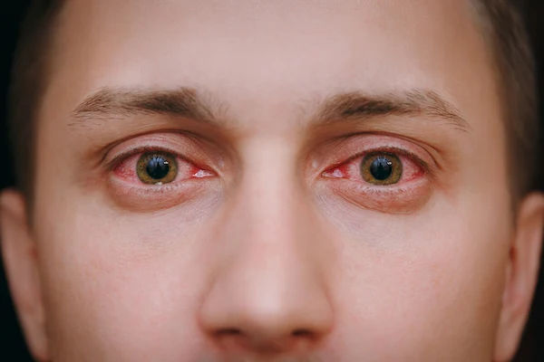 conjunctivitis