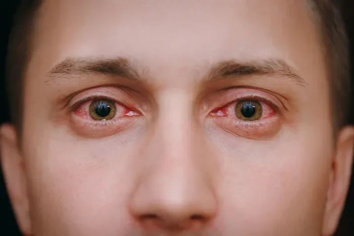 conjunctivitis