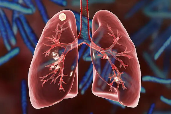 Tuberculosis Lungs