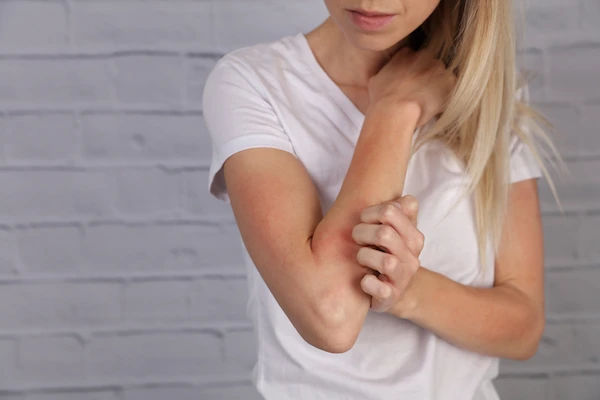 Treatments for Eczema