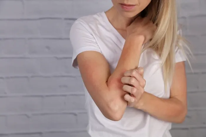 Treatments for Eczema