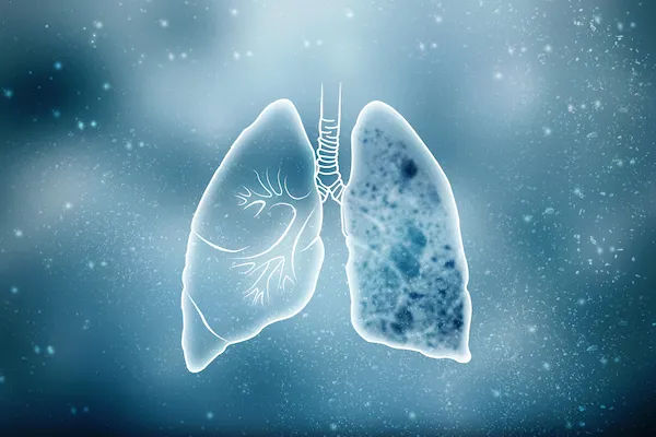 tuberculosis