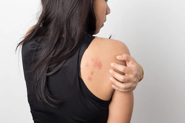 Skin Diseases