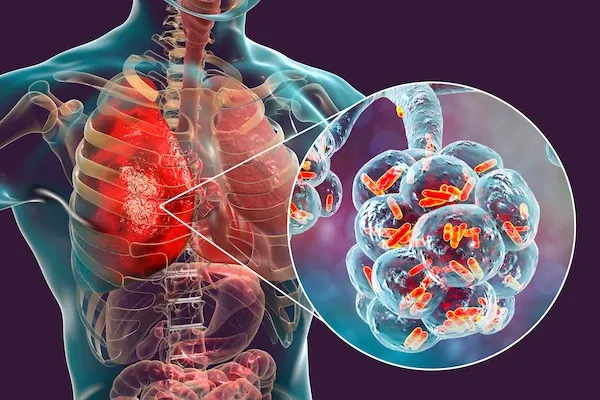 pneumonia