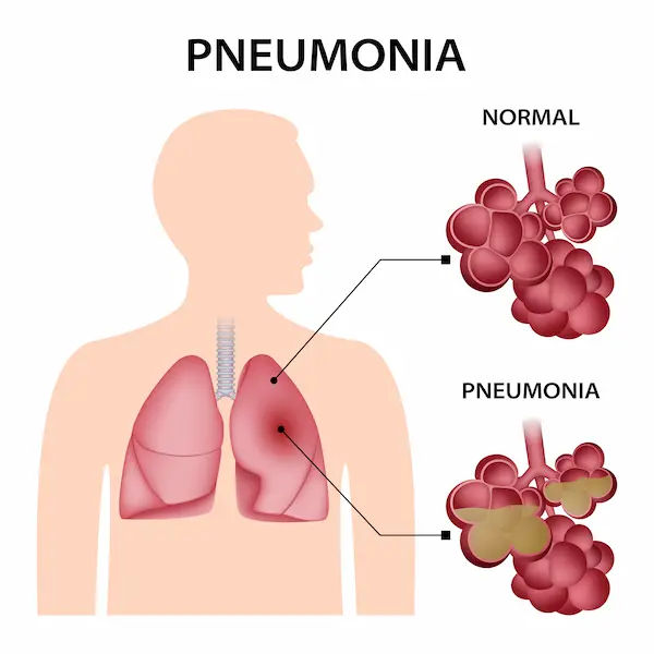 Pneumonia