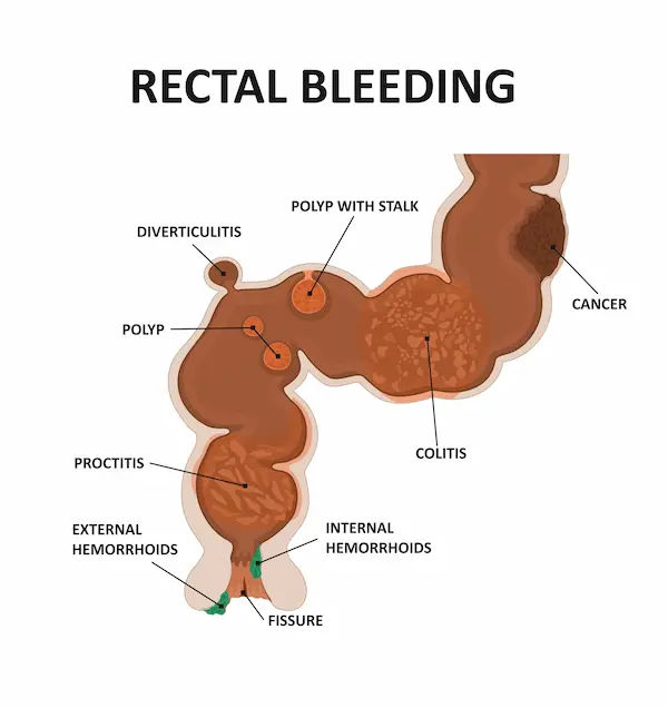 Rectal Bleeding