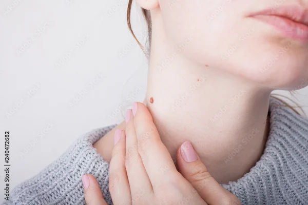 Natural Remedies for Neck Wart Removal