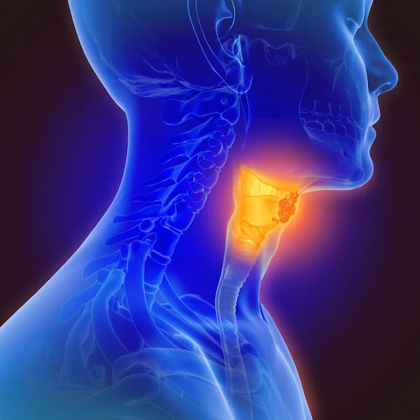 Oropharyngeal Cancer Symptoms Explained