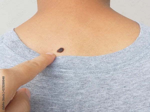 Types of Black Birthmarks Explained