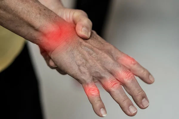 Difference Between Osteoarthritis and Rheumatoid Arthritis