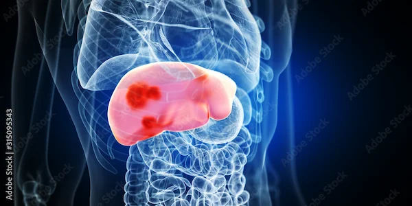 Liver Cancer Medications and Treatment Options