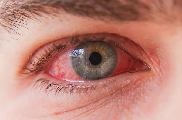 Conjunctivitis Signs and Symptoms Explained