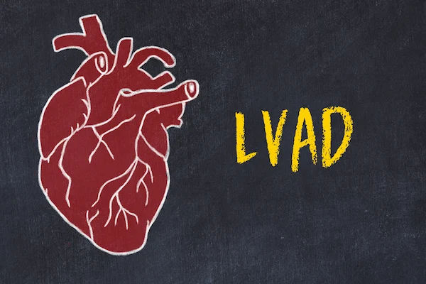 lvad