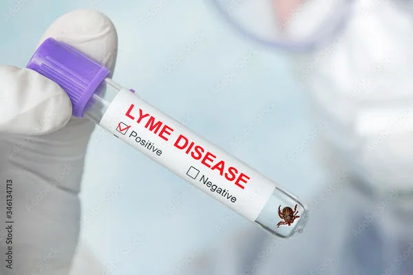 Lyme Disease Overview and Management