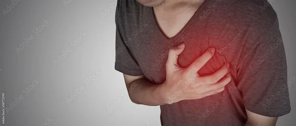 Myocardial Infarction Treatment Overview