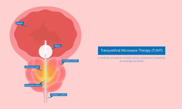 Urethral Stricture Overview and DiagnosiS