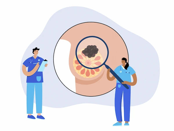 Nipple Sparing Mastectomy