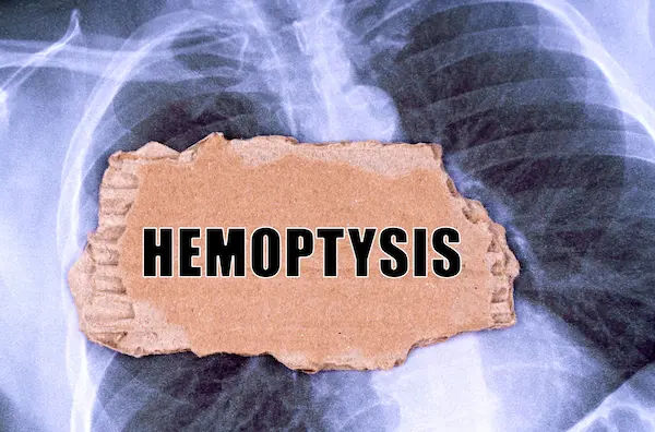 Hemoptysis