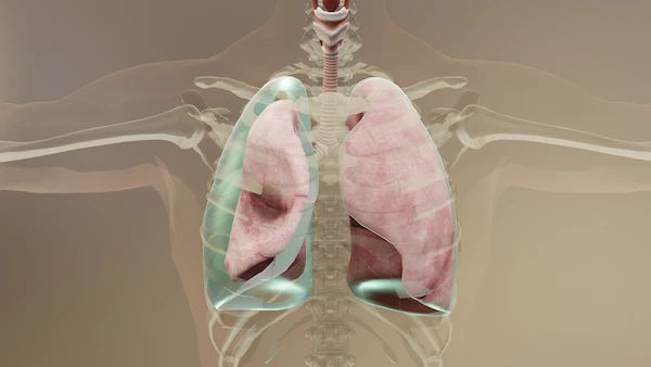 pneumothorax
