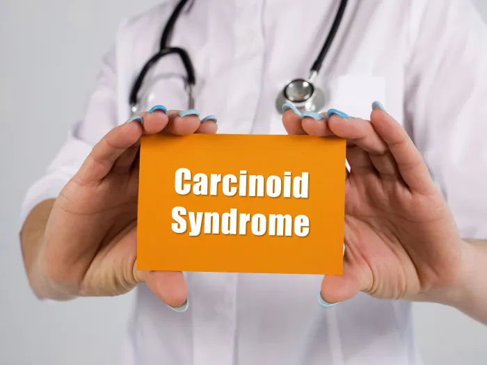 Carcinoid Syndrome Overview and Management
