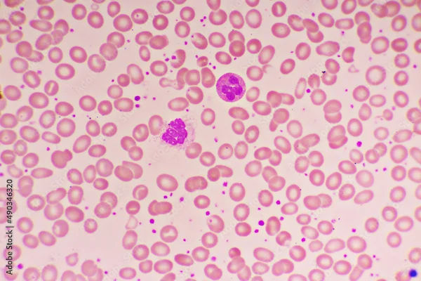 Understanding Thrombocytosis: Causes and Types