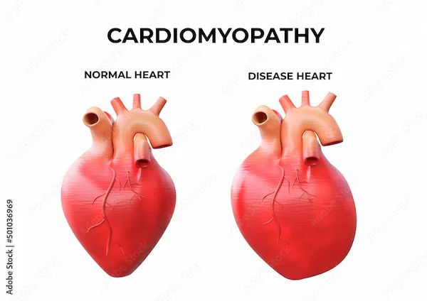 Cardiomyopathy: Overview of Symptoms and Treatment