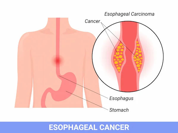 Esophageal Cancer Symptoms Overview