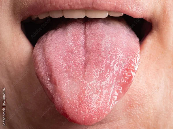 Early Stage Tongue Cancer: Key Signs to Spot