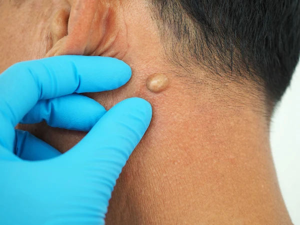 lipoma