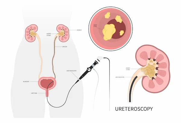 Ureteric Calculus Removal Methods Explained