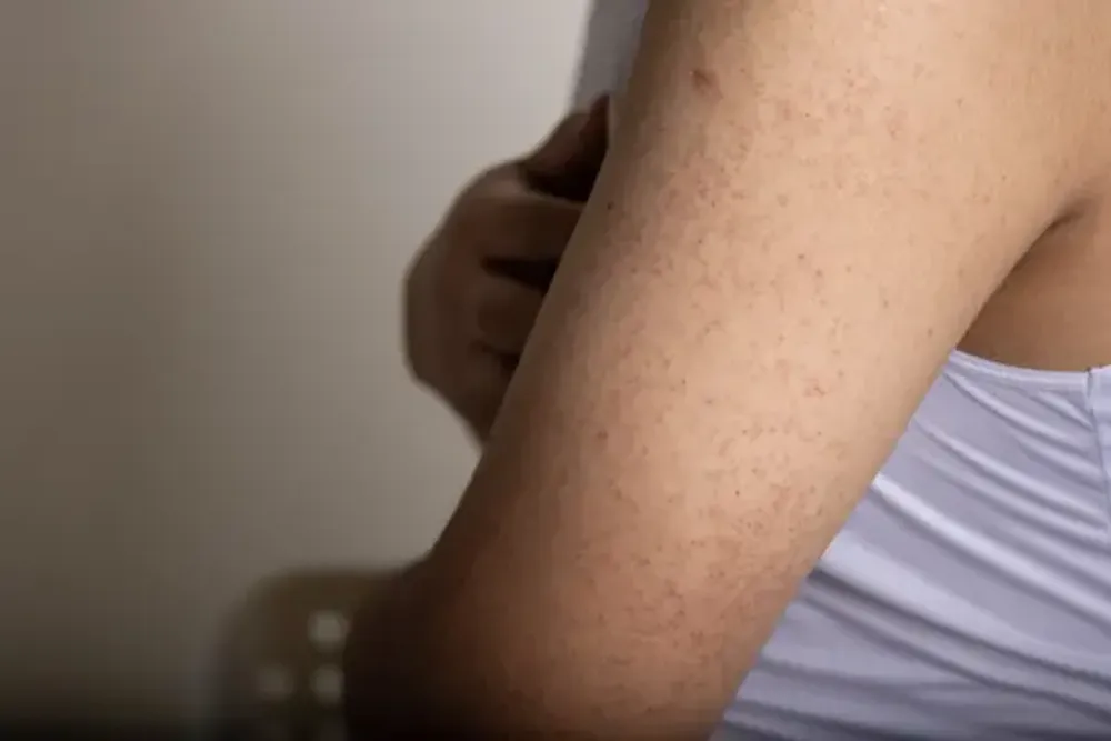 ghk cu keratosis pilaris Keratosis pilaris main image 1