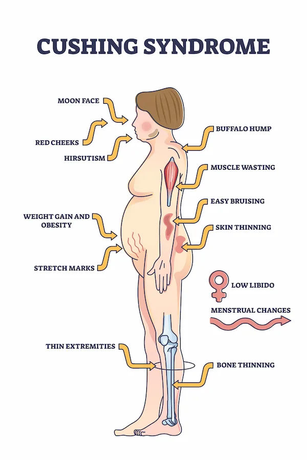 Cushing Syndrome Overview and Management