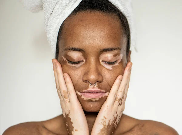 Vitiligo Overview: Symptoms, Causes, and Treatment