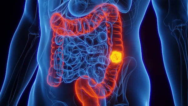 What is Colon Cancer and Its Symptoms?
