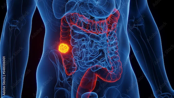 Stage 1 Colon Cancer Symptoms Explained